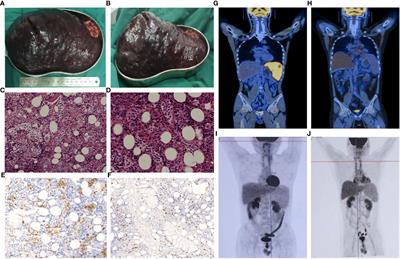 Allo-HSCT with TBI-based preconditioning for hepatosplenic T-cell lymphoma: two case reports and systematic review of literature